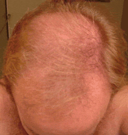 FOLIGAIN Low Alcohol Minoxidil 5% Hair Regrowth Treatment For Men 12 Month Supply - FOLIGAIN EUROPE